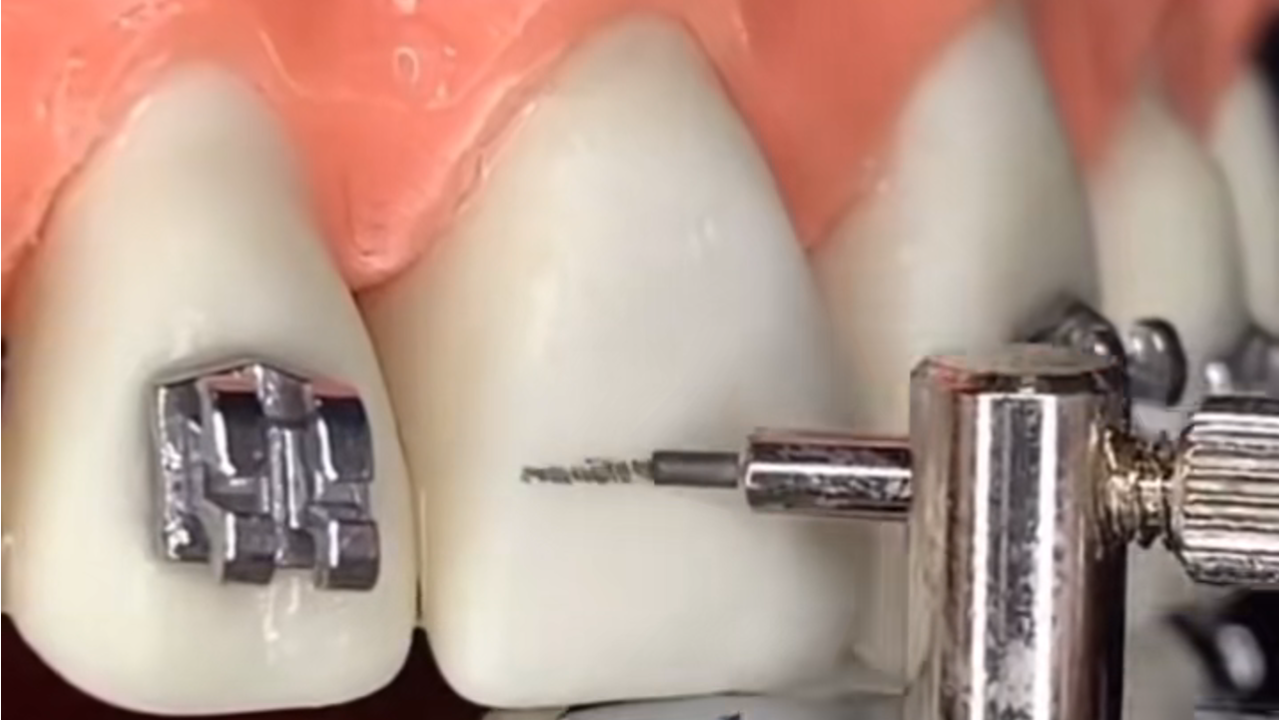 大人の歯列矯正は諦める必要がある？東京でできる費用対効果の高い選択肢